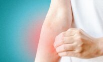 Urticaria, Eczema, and Shingles: How TCM Remedies Soothe Seasonal Skin Problems