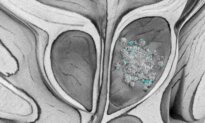 Microplastics Found in 9 of 10 Prostate Cancer Samples in Pilot Study