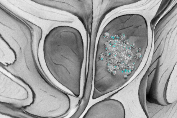 New Prostate Study Reveals Unexpected Contamination