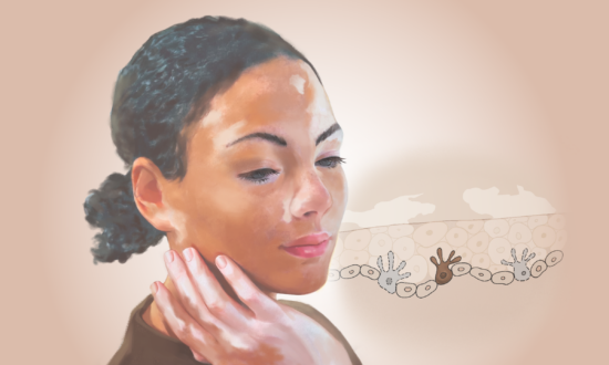Vitiligo: The Autoimmune Condition That Turns Skin Against Itself–Here Are the Causes