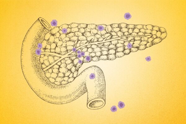  Pancreatic Cancer: Key Signs Often Overlooked