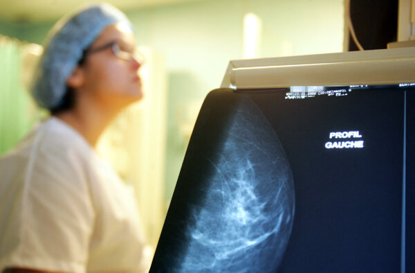 New Recommendations on Breast Cancer Screening: American College of Physicians