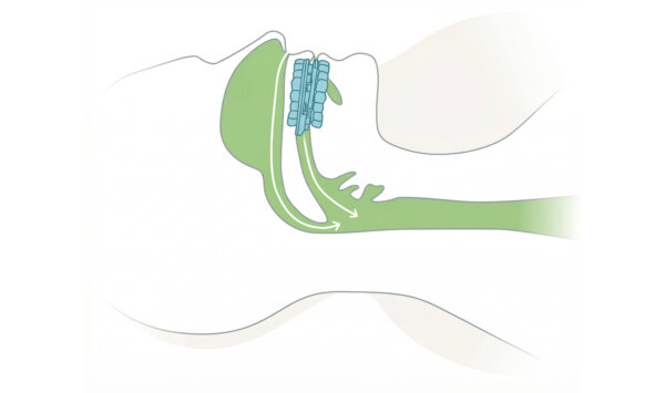 SnoreRX is a new doctor-recommended and FDA-cleared device is now helping millions of people stop snoring instantly.