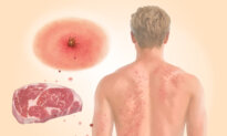 Alpha-Gal Syndrome: How a Tick Bite Triggers Sensitivity to Meat–Here Are the Causes