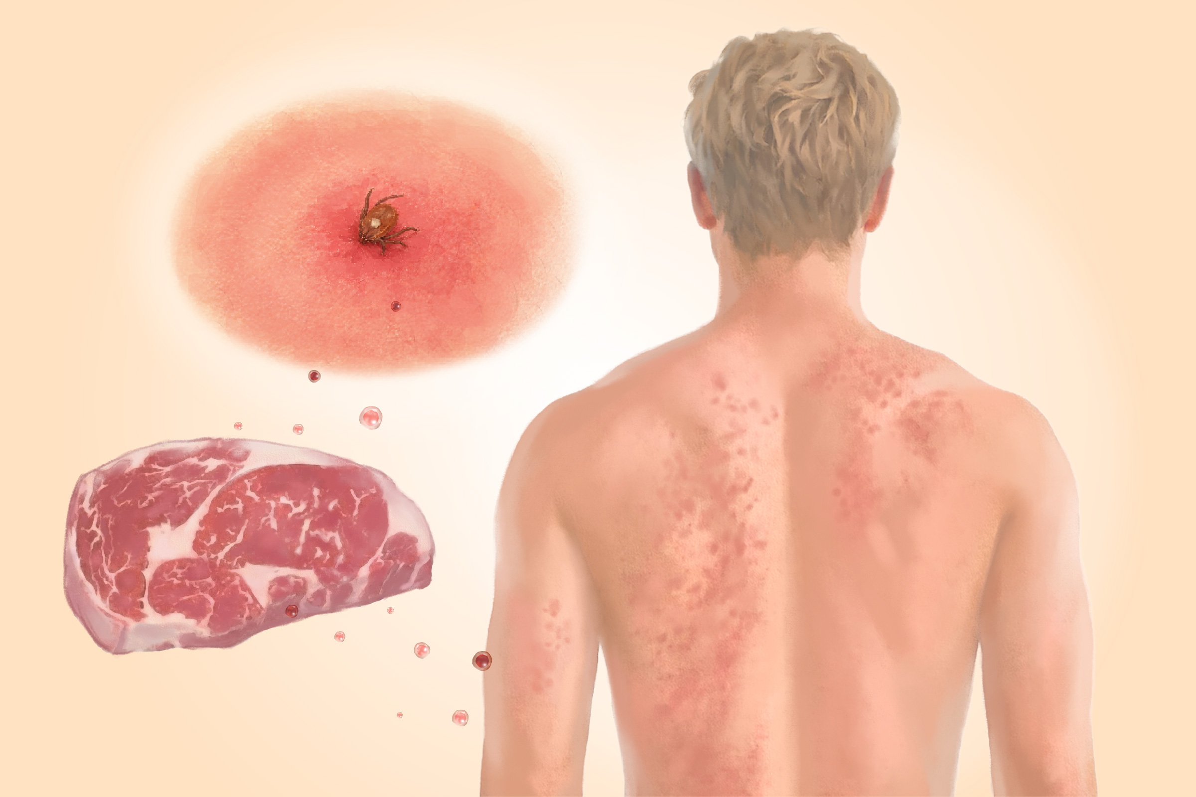 Alpha-Gal Syndrome: How a Tick Bite Triggers Sensitivity to Meat–Here Are the Causes