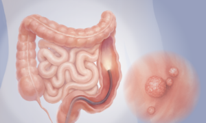 Colonoscopy: The Most Used Screening Test for Colon Cancer, Here Are the Benefits and Risks