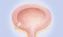 Bladder Cancer: Most Common Cancer of the Urinary System–Here Are the Warning Signs