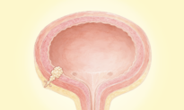 Bladder Cancer: Most Common Cancer of the Urinary System–Here Are the Warning Signs