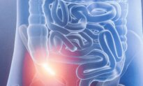 Removing the Appendix Linked to Higher Alzheimer’s Risks