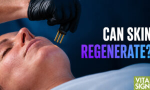 Nitrogen Plasma: Skin Treatment Hope for Acne Scars, Wrinkles, Sagging?