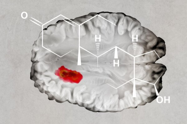 Testosterone May Slow Brain Cancer Growth