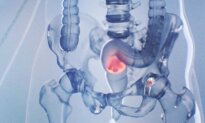 More Young Adults Are Dying From Rectal Cancer–Early Signs Often Go Unnoticed
