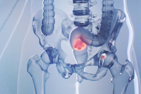 More Young Adults Are Dying From Rectal Cancer–Early Signs Often Go Unnoticed