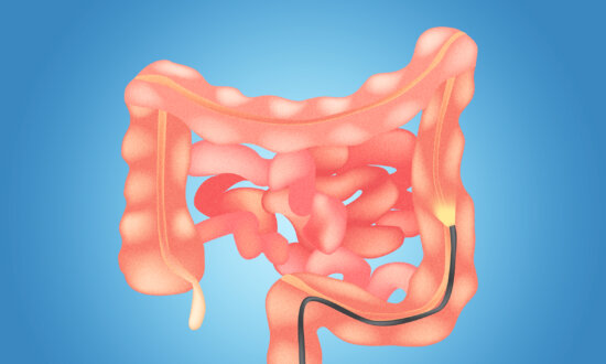 Single Sigmoidoscopy Cuts Colorectal Cancer Risk for More Than 20 Years