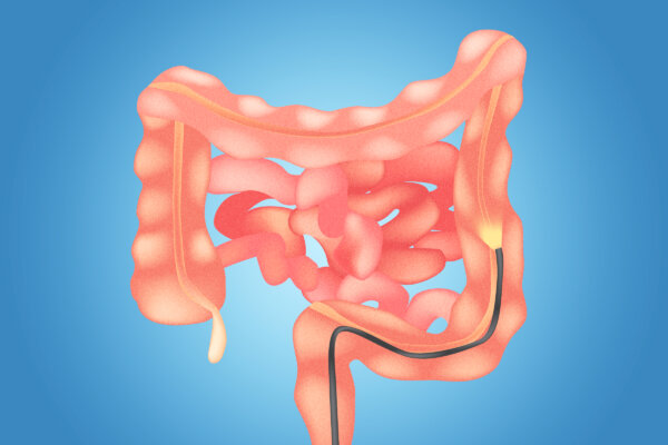 Single Sigmoidoscopy Cuts Colorectal Cancer Risk for More Than 20 Years