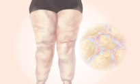 Lipedema: The Abnormal Fat Buildup Often Mistaken for Weight Gain–Here Are the Causes