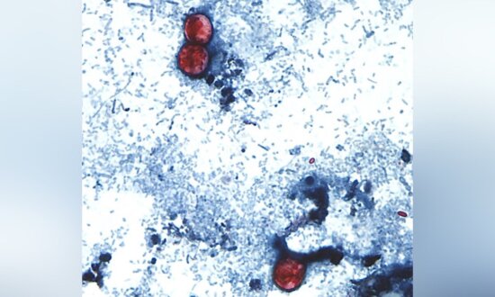 Infections From Diarrhea-Causing Parasite Soar Past 1,000 in Michigan