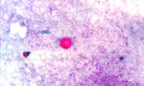 Cyclosporiasis: An Annual Summer Parasitic Infection–How to Protect Yourself