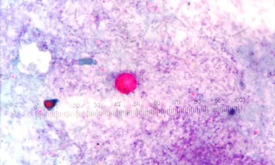 Cyclosporiasis: An Annual Summer Parasitic Infection–How to Protect Yourself