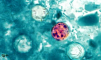 Outbreak of Diarrhea-Causing Parasite May Be Linked to Lettuce, Salad Greens: Officials