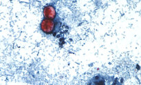 Cyclosporiasis Outbreak: Here’s the Latest Case Numbers by State