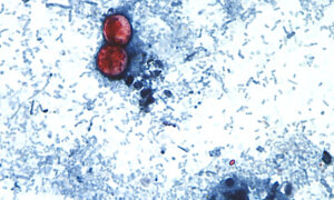 Cyclosporiasis Outbreak: Here’s the Latest Case Numbers by State