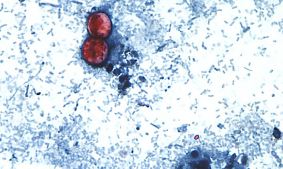 Disease Caused by Cyclospora Parasite Now in 45 States: CDC