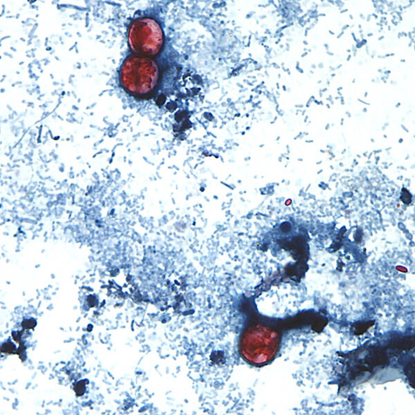 Cyclosporiasis Outbreak: Here’s the Latest Case Numbers by State