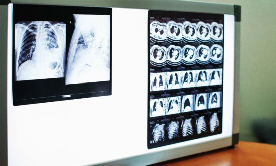 How One Man Defied One of the Deadliest Lung Cancers for More Than 7 Years