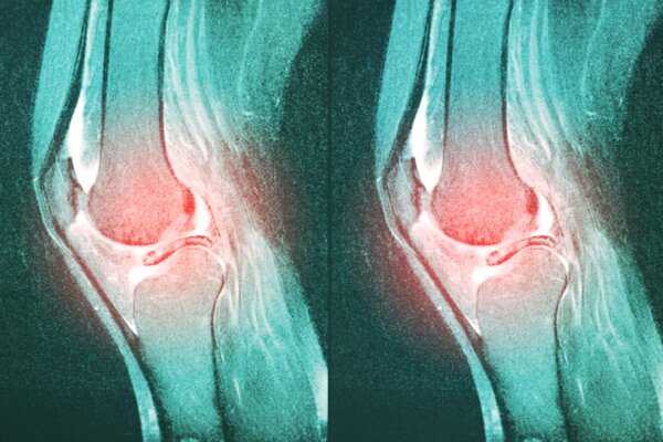  Common Knee Surgery May Do More Harm Than Good