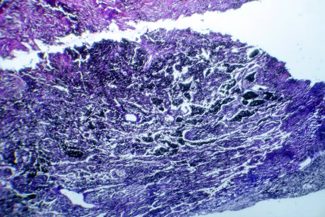 Photomicrograph of lung tissue depicting silicosis pathology under a microscope, revealing silica particle accumulation in alveoli and fibrosis. (Shutterstock)