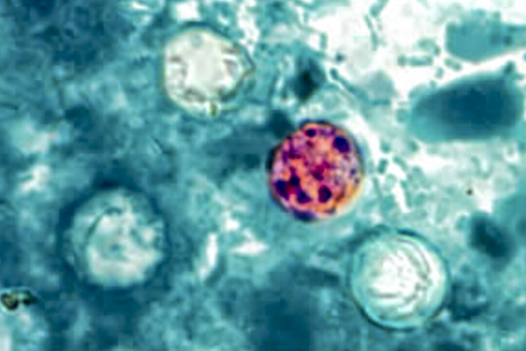 CDC Report: Parasite Causing Diarrhea Spreads Across America, 15,000 Cases Confirmed