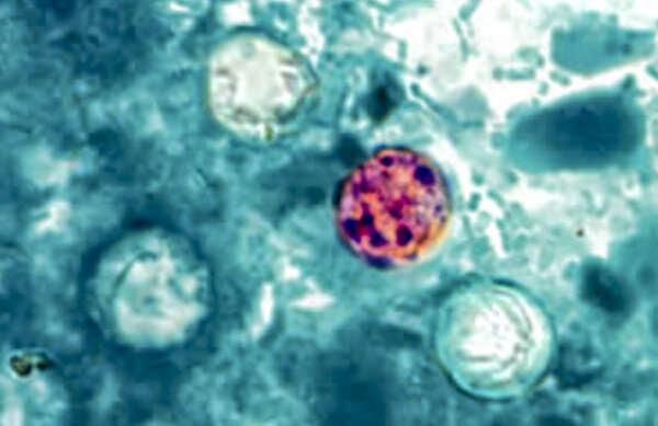 More Than 15,000 Cases of Parasite That Causes Diarrhea in US: CDC