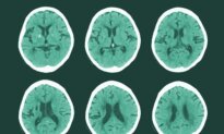 Warning Sign for Common Stroke May Not Be Blockages, Study Finds