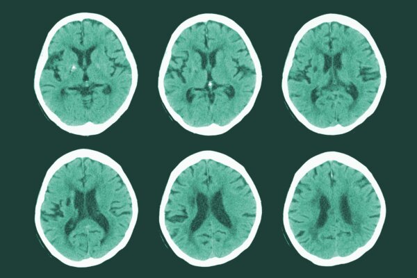 Warning Sign for Common Stroke May Not Be Blockages, Study Finds
