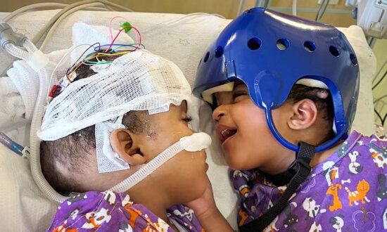 Conjoined Twins Get Chance at Better Life After Historic Separation Surgery in St. Louis Hospital