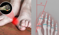 Foot Doctor Warns Bunion Sufferers: Treating The Wrong Problem Is Costing You Thousands Of Dollars – Without Any Relief!