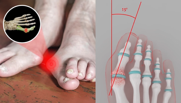 Foot Doctor Warns Bunion Sufferers: Treating The Wrong Problem Is Costing You Thousands Of Dollars - Without Any Relief!