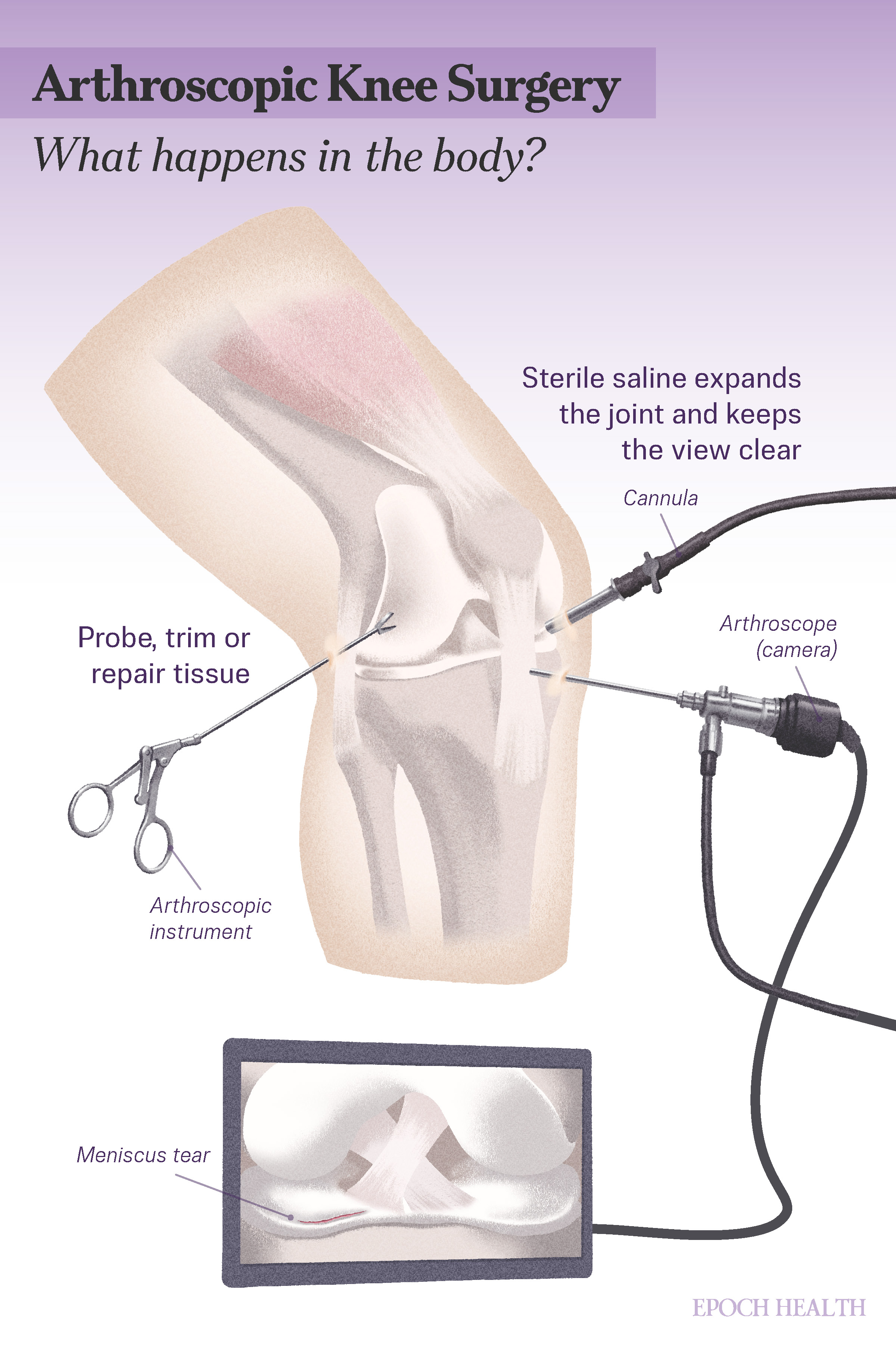Arthroscopic Knee Surgery infographic