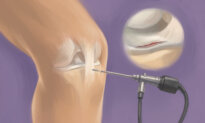 Arthroscopic Knee Surgery: One of the Most Common Orthopedic Procedures—Here’s What to Know