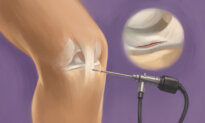 Arthroscopic Knee Surgery: One of the Most Common Orthopedic Procedures–Here’s What to Know