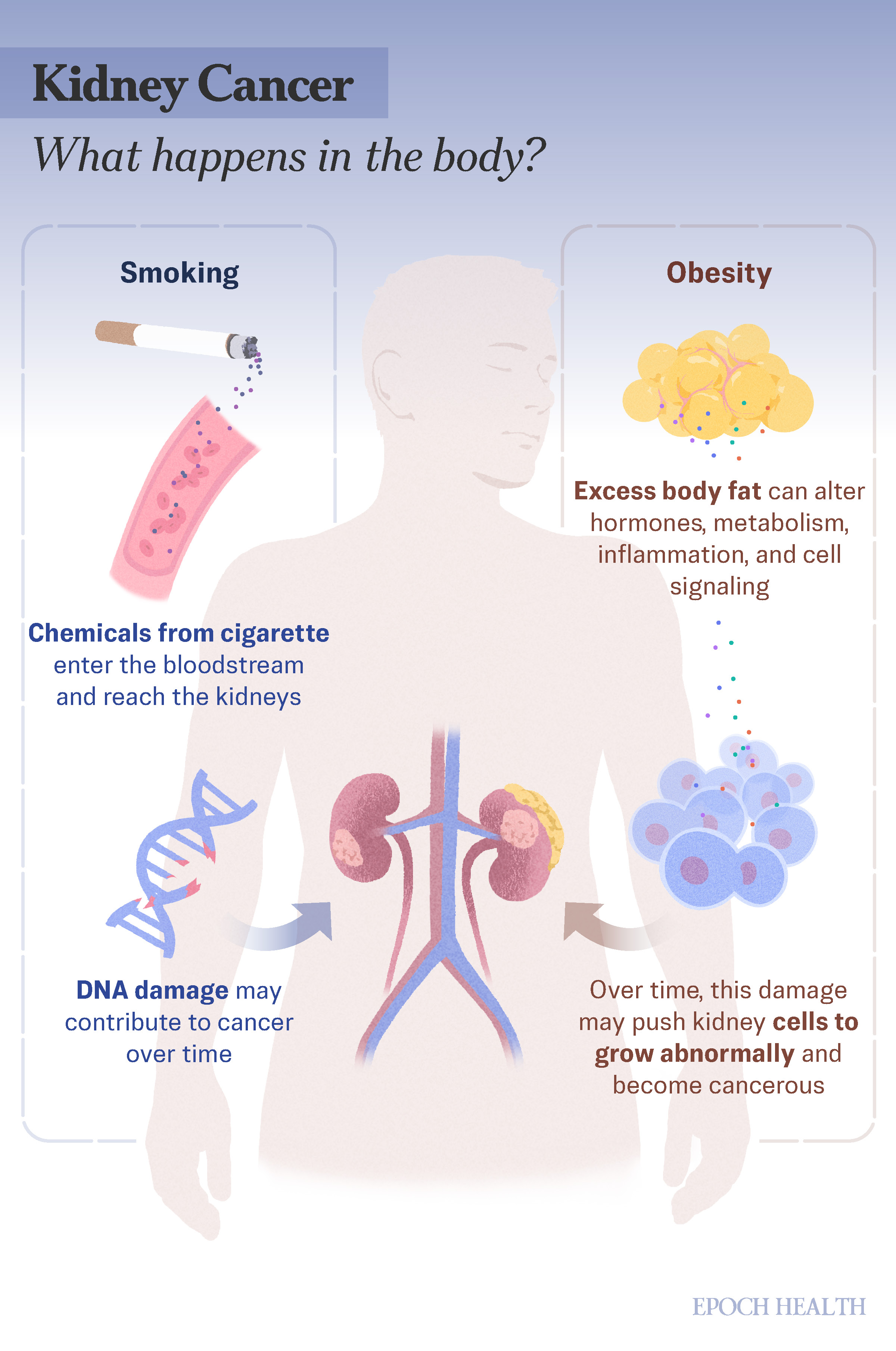 Kidney Cancer infographic