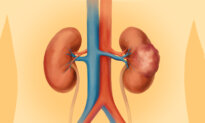 Kidney Cancer: One of the 10 Most Common Cancers—Here are the Symptoms