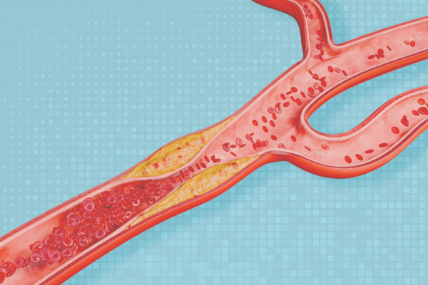 This Saturated Fat Slows Heart Disease