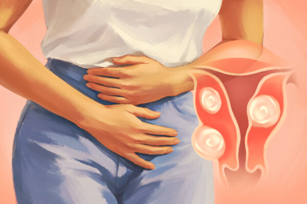 Uterine Fibroids: Affect Up to 70 Percent of Women By Age 50—Here Are the Causes
