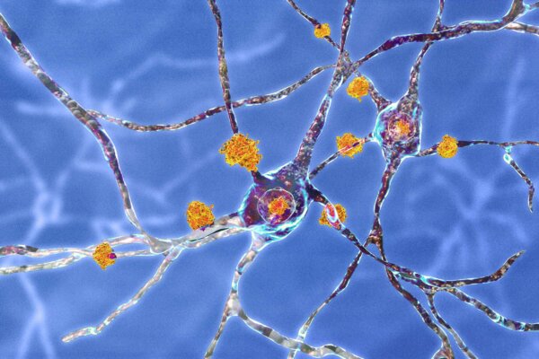 Intermittent Fasting May Help Slow Huntington’s Disease: Pilot Study